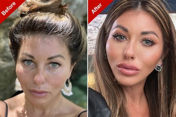 Which Celebrity Has Had the Most Plastic Surgery? Exploring Transformations in the Spotlight